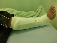 %e8%b6%b3%e9%a6%96%e5%89%a5%e9%9b%a2%e9%aa%a8%e6%8a%98%e3%80%80%e5%9b%ba%e5%ae%9a